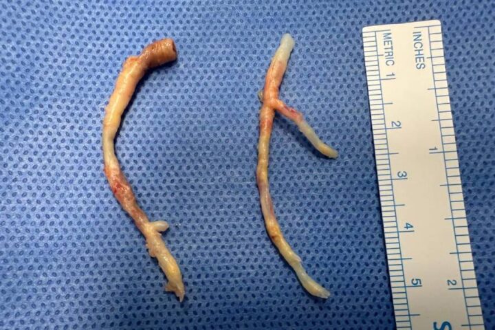 16.43M Specimen LAD & RCA Endarterectomy Long (2)