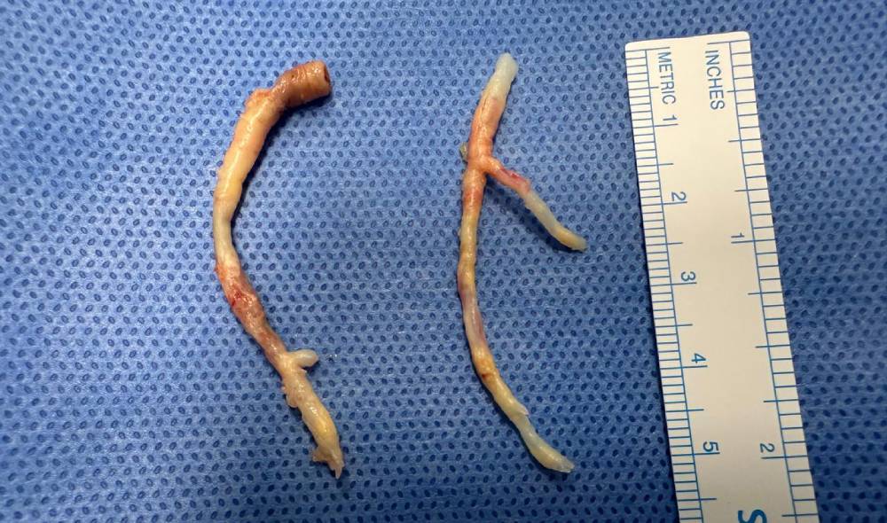16.43M Specimen LAD & RCA Endarterectomy Long (2)
